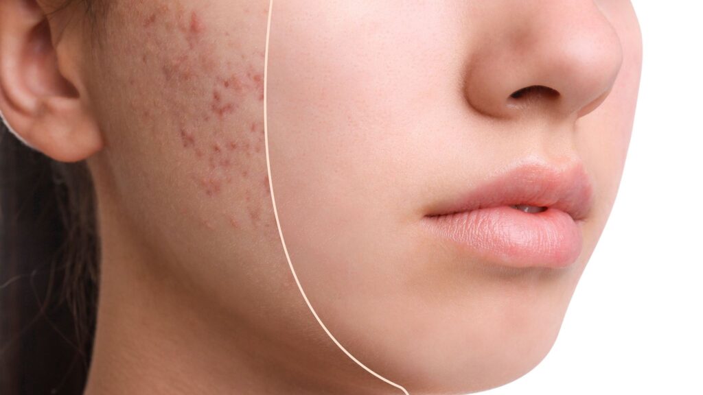 Revitalize Your Skin with Microneedling Treatment for Acne Scars in Calgary