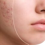 Revitalize Your Skin with Microneedling Treatment for Acne Scars in Calgary